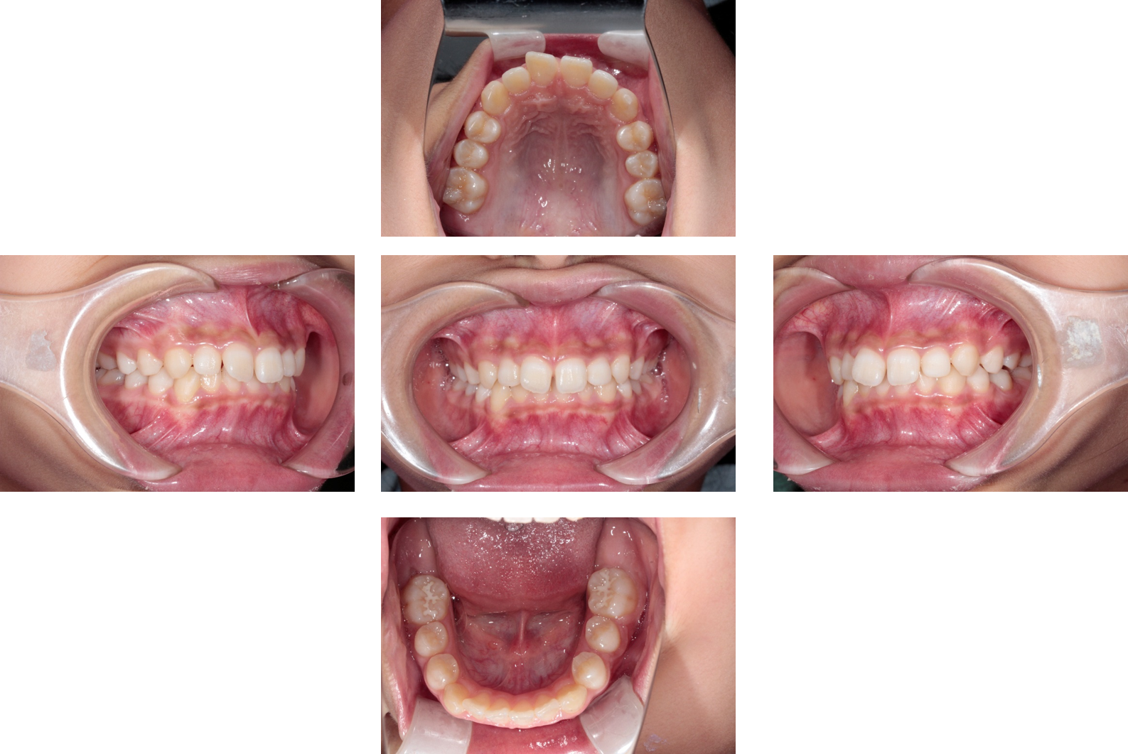 元住吉の歯医者の咬合誘導治療症例