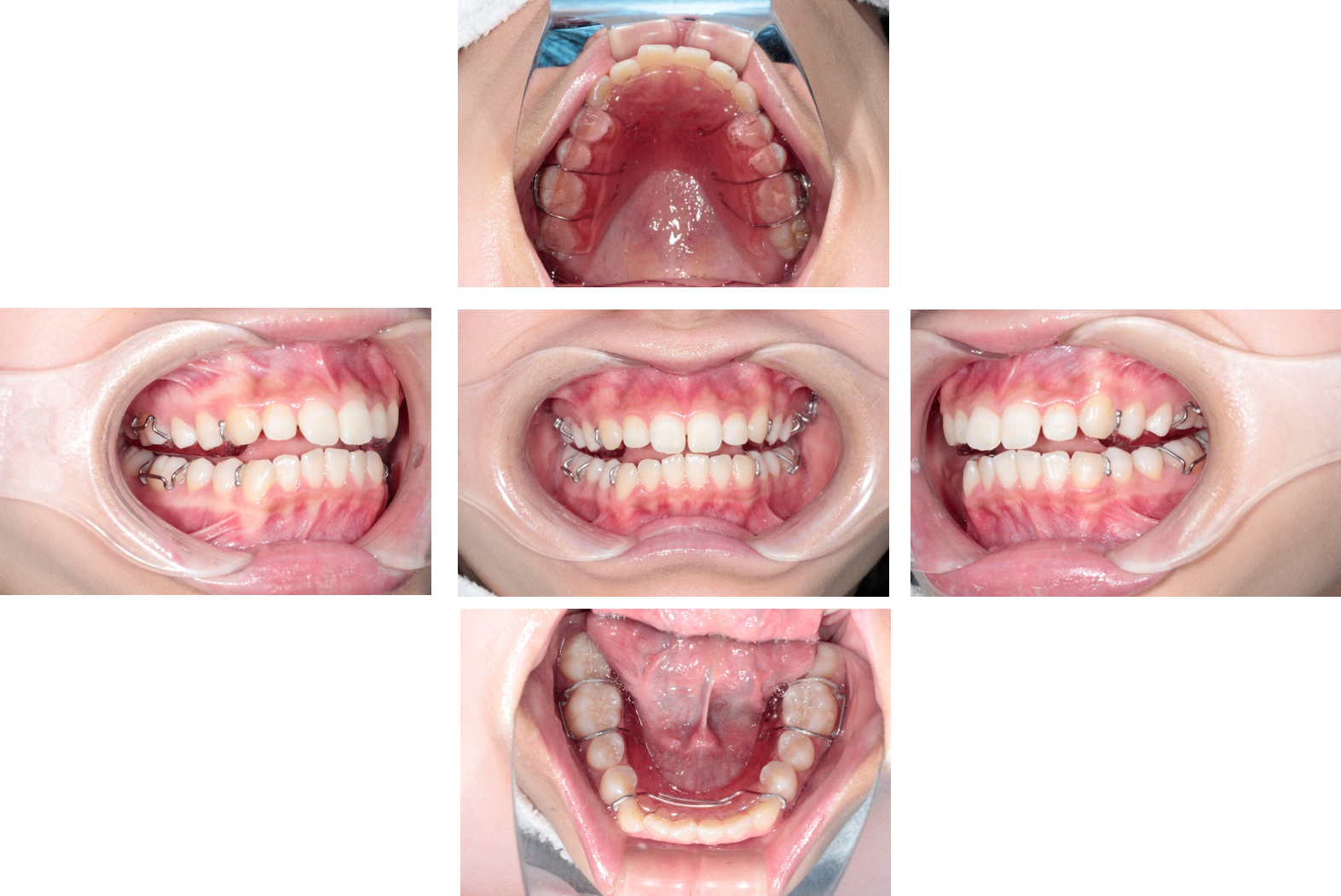 元住吉の歯医者の咬合誘導治療症例