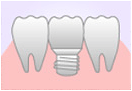 元住吉の歯医者でインプラント治療とブリッジとの比較