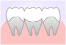 元住吉の歯医者でインプラント治療とブリッジとの比較