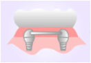 元住吉の歯医者でインプラント治療と入れ歯との比較