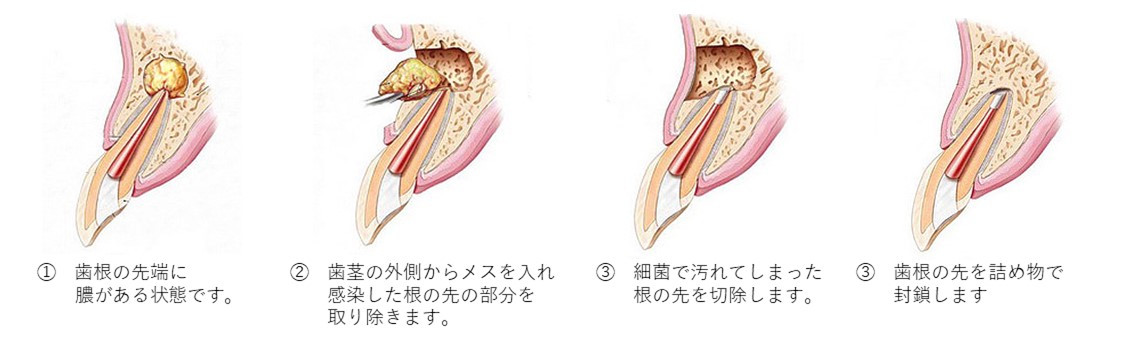 元住吉の歯医者で歯を残す「接着治療技術」