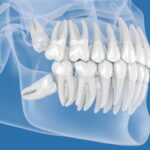 元住吉の歯医者、よしだ・ファミリー・歯科で親知らずの抜歯について解説