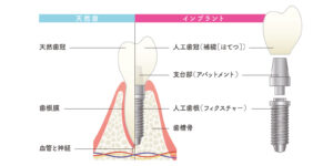元住吉の歯医者なら、駅徒歩3分、土日も診療で通いやすい、よしだ・ファミリー・歯科で、インプラント周囲炎とインプラント周囲粘膜炎はどう違う？原因や治療法・予防法を解説